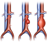 מפרצת בטנית: רוצח שקט-תמונה